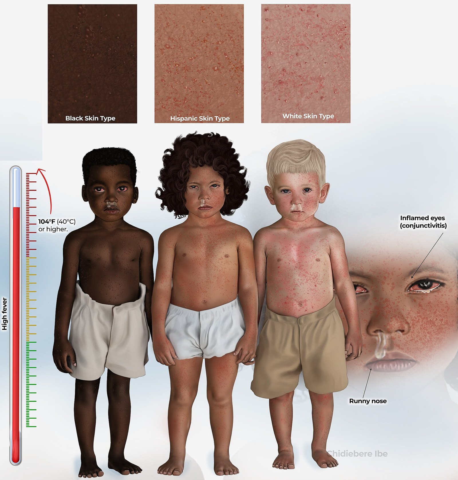 U.S. Measles Cases Hit 3-Decade High in 2026